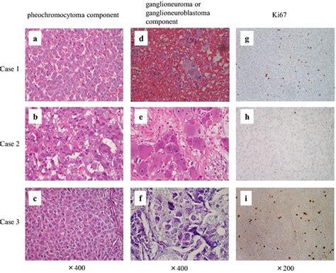 Composite Pheochromocytoma Of The Adrenal Gland A Case Series Bmc Research Notes Full Text