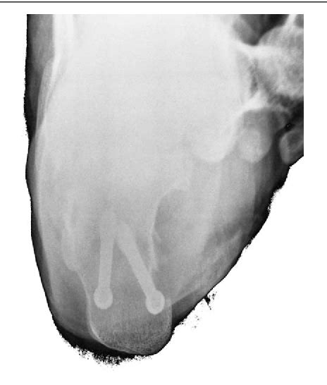 Figure 2 From Arthroscopic Assisted Percutaneous Fixation Of Intra