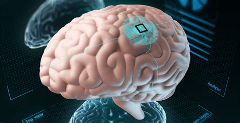 Inteligencia Artificial Salud Implantes Cerebrales Electr Nicos M S