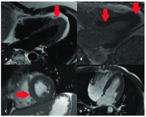 Asymmetric Hypertrophic Cardiomyopathy With Apical Hypertrophy As