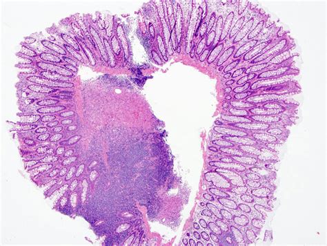 Pathology Outlines Langerhans Cell Histiocytic Neoplasms