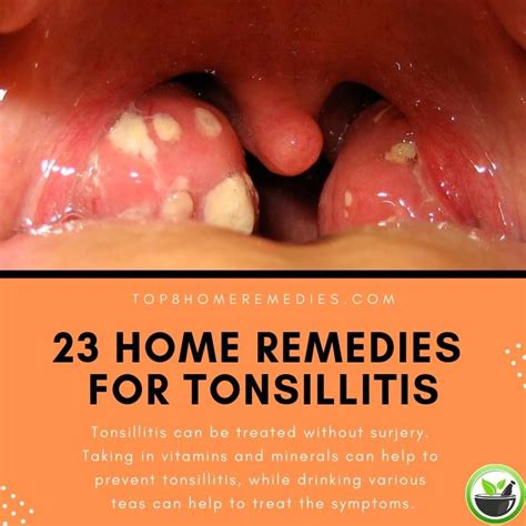 Tonsil Swelling