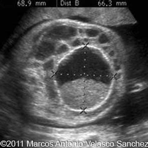 📃 Ovarian cyst, 30-38 weeks