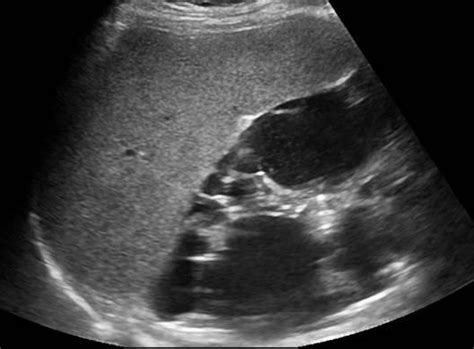 Abdomen and retroperitoneum | 1.1 Liver : Case 1.1.4 Liver cysts ...