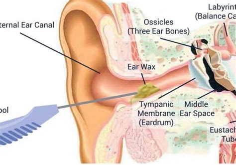 Ear Wax Removal Using Microsuction Clear Ears Clinic