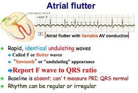 Atrial flutter symptoms - bezypolice