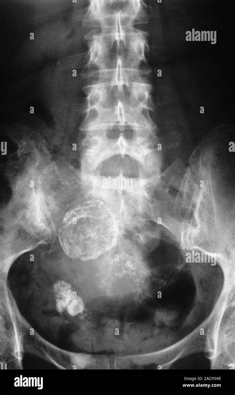 Pelvic X-ray (front view) showing calcified cysts in a woman's ovary ...