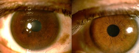 Slit Lamp Image Of The Anterior Segment In A Patient With Unilateral