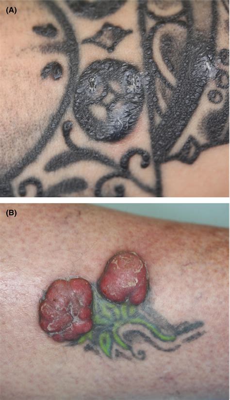 Kidney Transplant Scar Tattoo