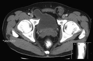 Inguinal Hernia Repair | Basicmedical Key