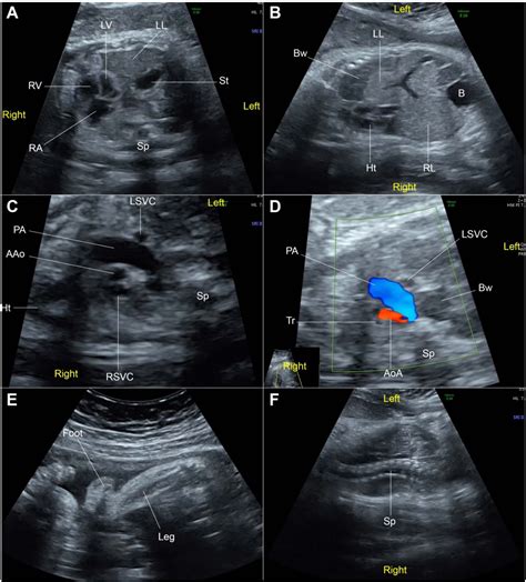 Figure 1 From Prenatal Sonographic Features Of Ring Chromosome 15 A