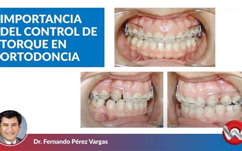 Importancia Del Control De Torque En Ortodoncia Odonto Science