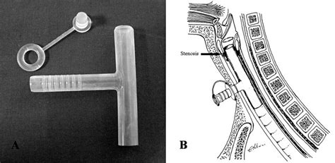 Emergency Airway Management In A Patient With A T Tube Tracheal Stent