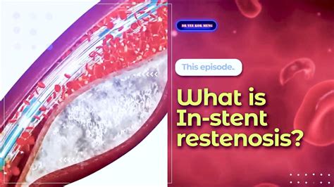 What Is In Stent Restenosis Youtube