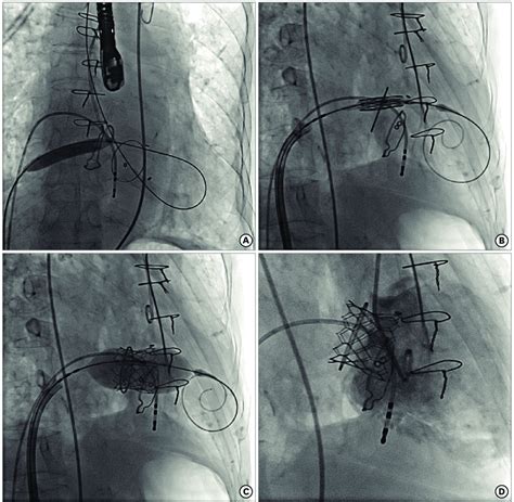 A Balloon Atrial Septostomy With 10×40mm Balloon B Positioning Of