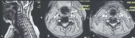 Preoperative Mri Sagittal Image Of The Cervical Myelon Axial