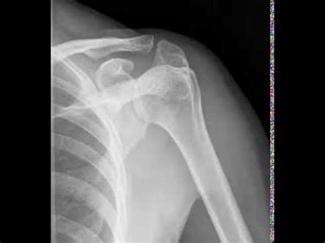 View Standard Shoulder Radiographic Tutorial Youtube