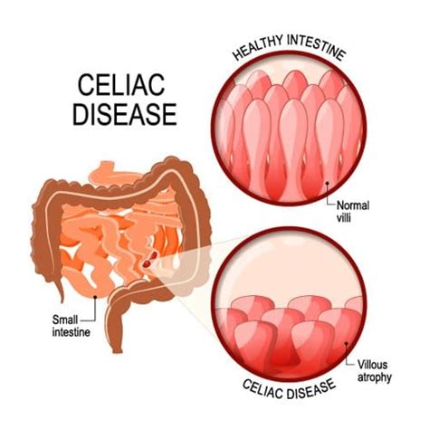 What You Should Know About Celiac Disease