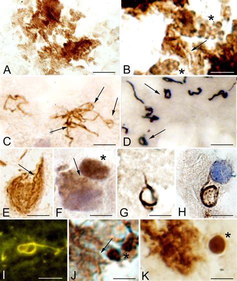 Persisting Atypical And Cystic Forms Of Borrelia Burgdorferiand Local