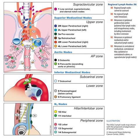 Tnm Classification Of Nsclc Patients And Schematic Representation Of Download Scientific