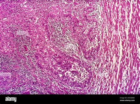 Tubal Ectopic Pregnancy Light Micrograph Of A Section Through Tissue From A Fallopian Tube In