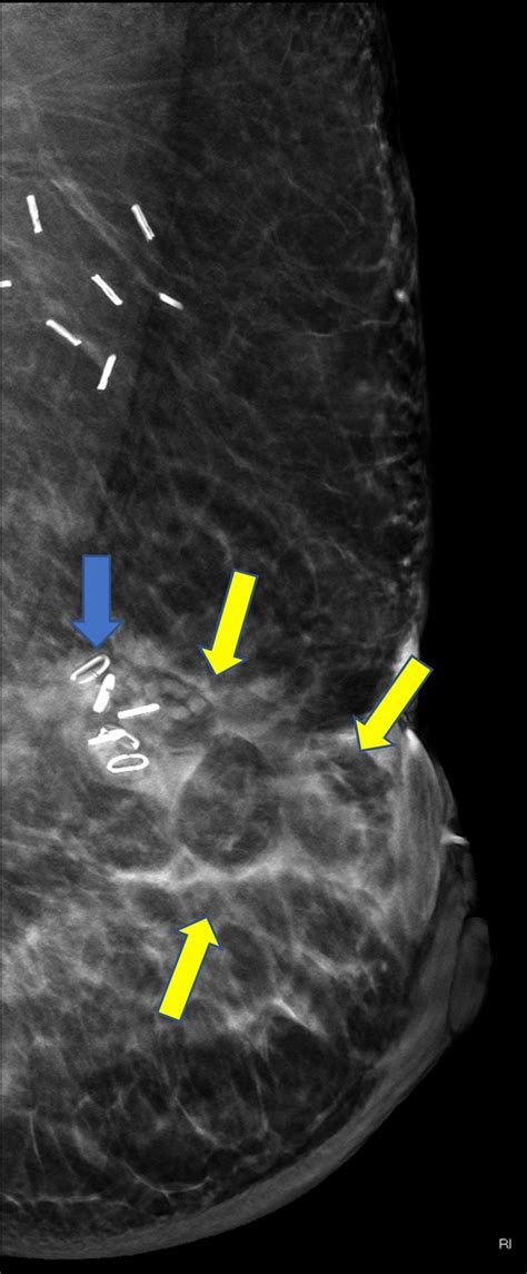 Year Old Female With Multifocal Left Breast Invasive Ductal