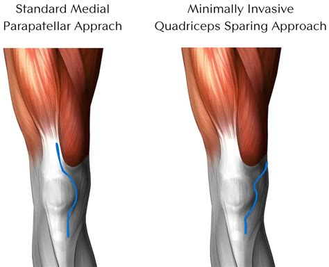 First Zimmer Biomet Persona Iq Smart Total Knee Replacement Placed At