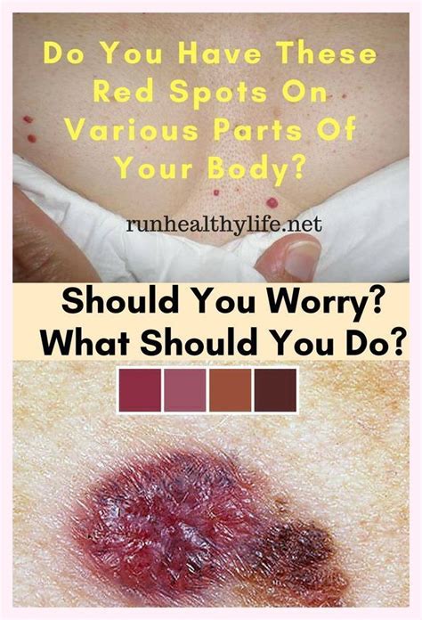 Do You Have These Red Spots On Various Parts Of Your Body Should You