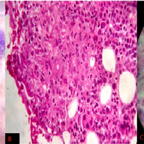 A Bone Marrow Aspiration Giemsa Stain X Magnification Showing