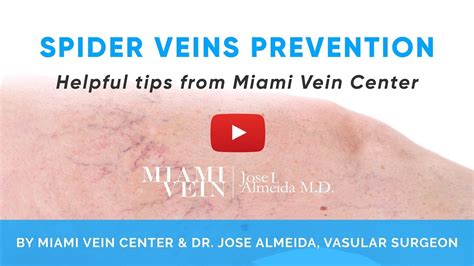 Guide To Spider Veins Prevention By The Miami Vein Center Youtube