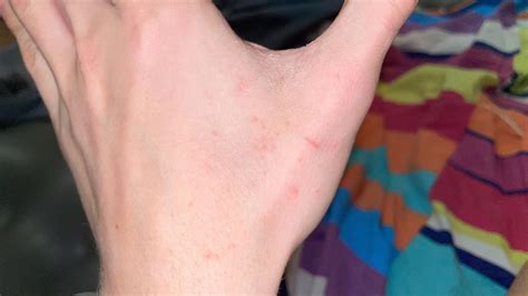 Post scabies or reinfection? Showers still itch, also evening itching