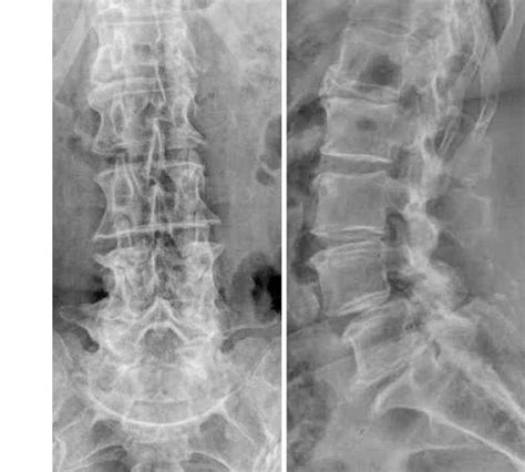 Preoperative Ap And Lateral Plain Radiographs Of The Lumbar Spine