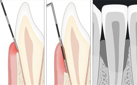 Diagnosi Della Parodontite Ulteriori Informazioni Periodontal Health