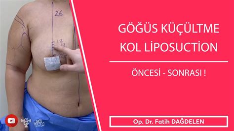 G S K Ltme Kol Liposuction Ameliyat Youtube