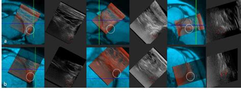 Anterolateral horn (a) and lateral (b) meniscus on MRI-US manually... | Download Scientific Diagram