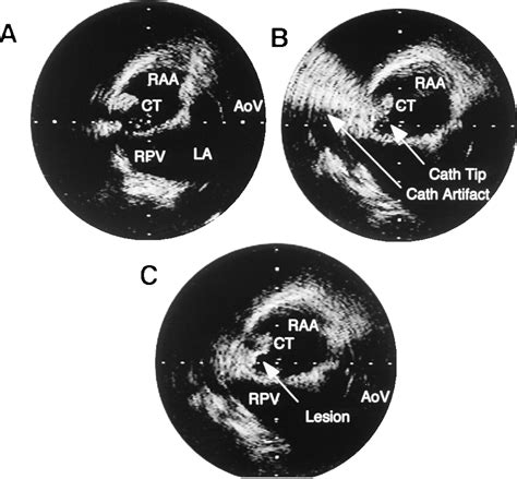 Radiofrequency Catheter Modification Of The Sinus Node For