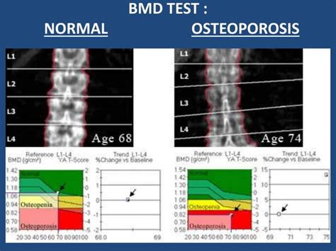 Bone Mineral Density Bmd Test Ppt