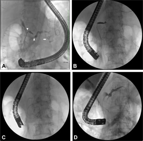 Dilation Of Pancreatic Duct Strictures With A Percutaneous Transluminal Angioplasty Catheter