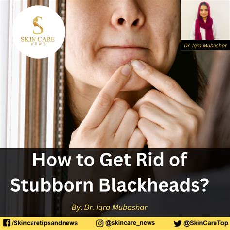 How to Get Rid of Stubborn Blackheads?