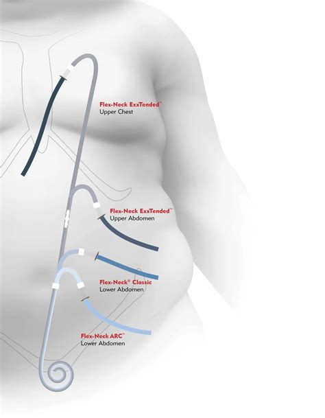Dialysis Catheter Types