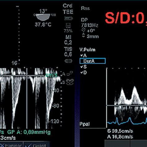 A Estenosis Mitral Doppler Color B Patron Doppler Pulsado De VP