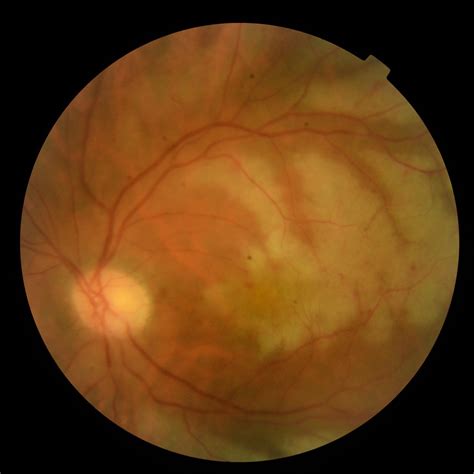 Acute Retinal Necrosis By Herpes Simplex Virus Type 1 An Unusual