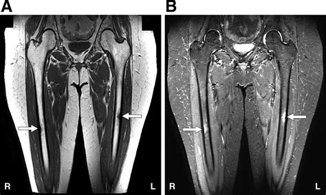 Femur Stress Fracture Mri