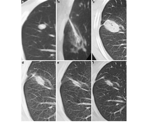 Sequential Computed Tomographic CT Images Demonstrating The Usual