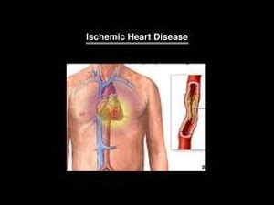 Ischemia: Types, Causes, Risk Factors, Symptoms and Treatment