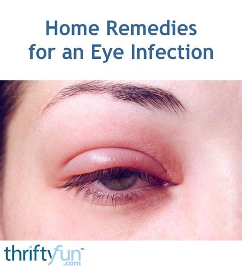 Home Remedies For An Eye Infection Thriftyfun