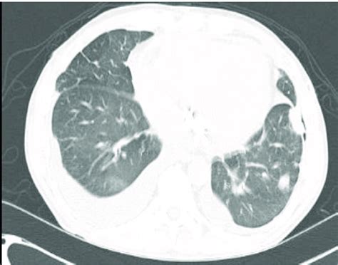 Ct Of The Chest Showing Multiple Parenchymal Lung Opacities And Download Scientific Diagram