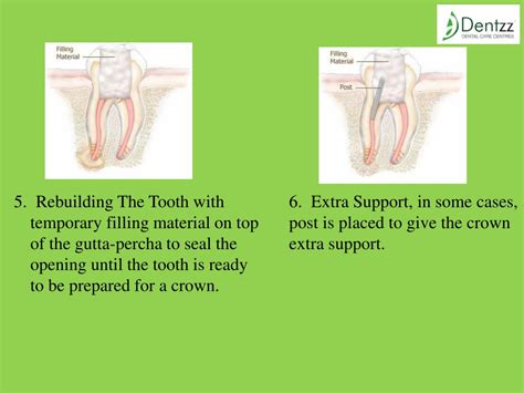 Ppt Painless Root Canal Treatment At Dentzz Powerpoint Presentation