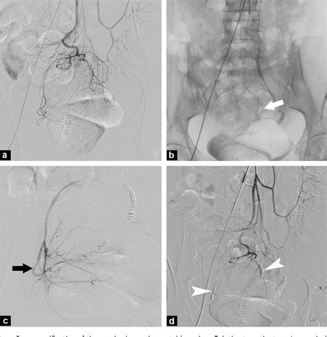 Figure 5 From Embolization Of The Hemorrhoidal Arteries The Emborrhoid