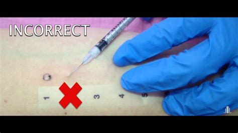 Intradermal Test Youtube